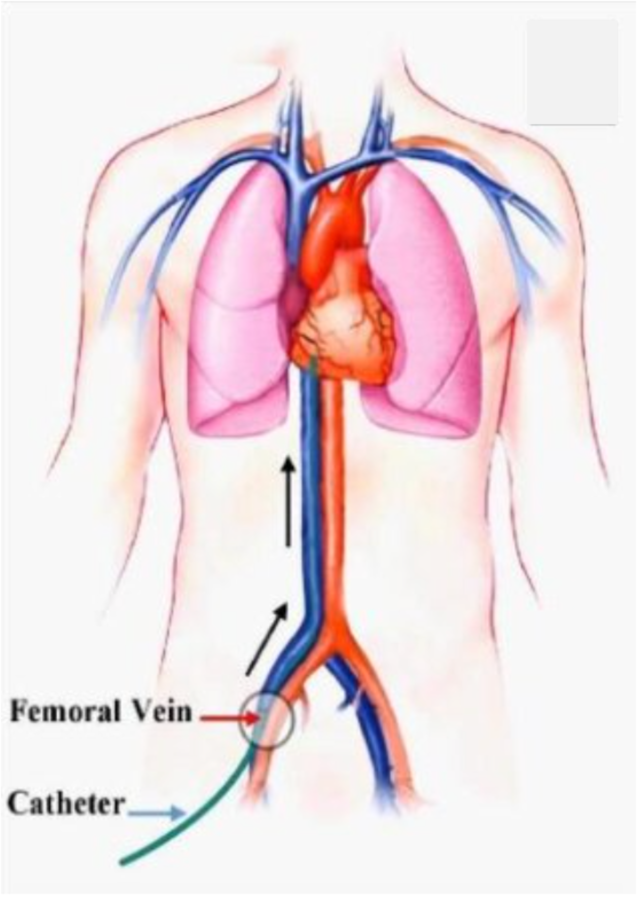 Why do they go through the leg for heart procedures?