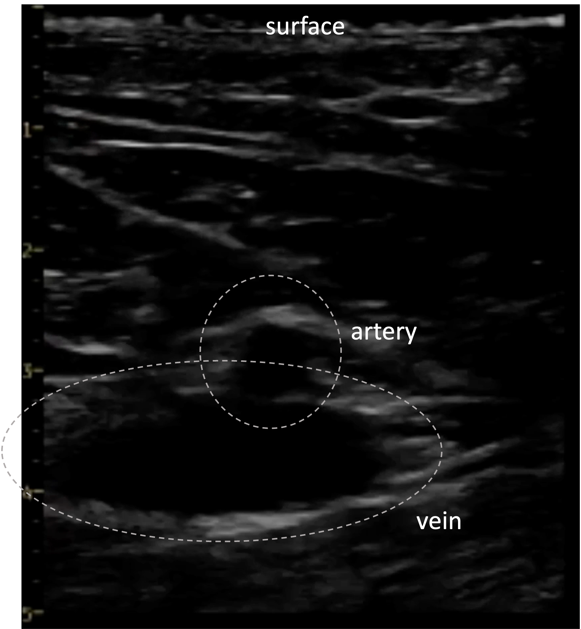 Why do they go through the leg for heart procedures?