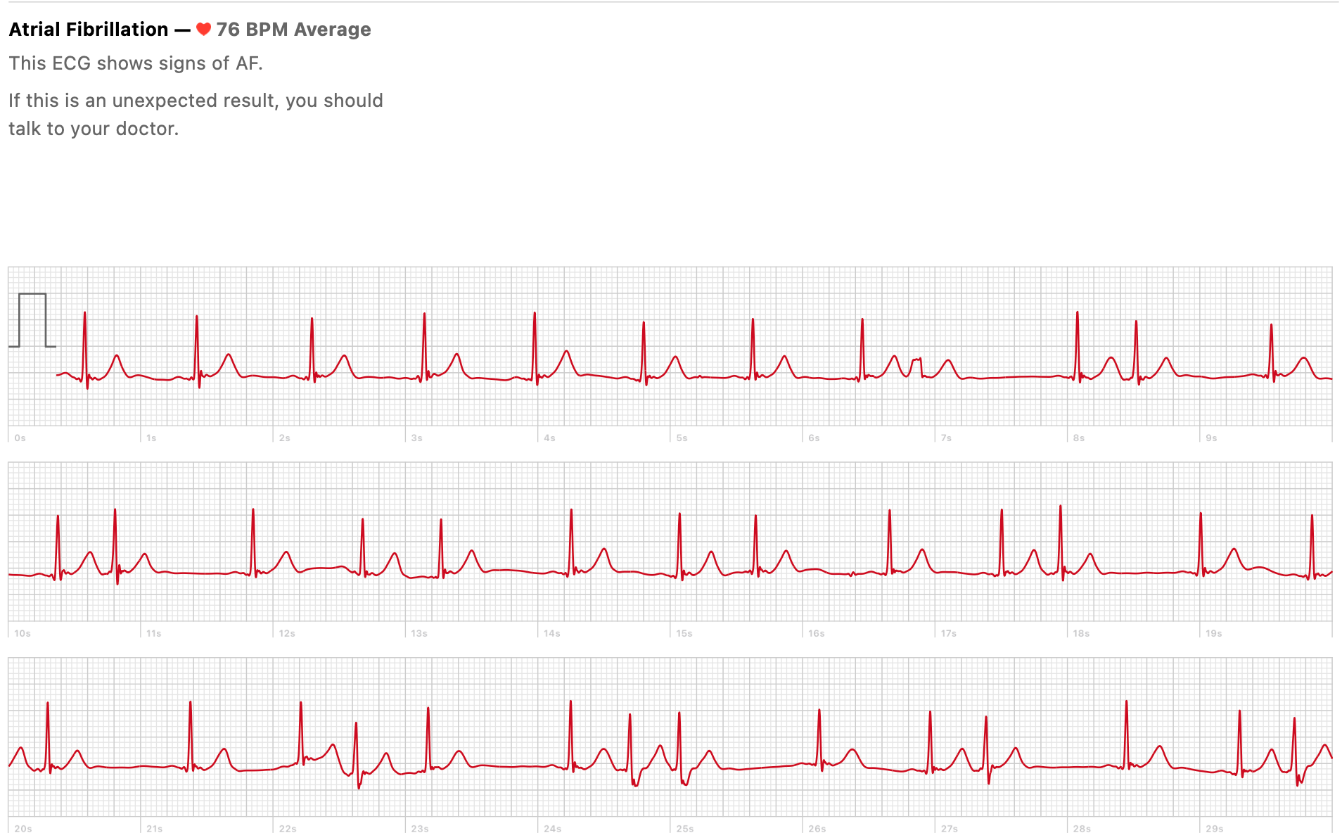 Extra heart beats after ablation