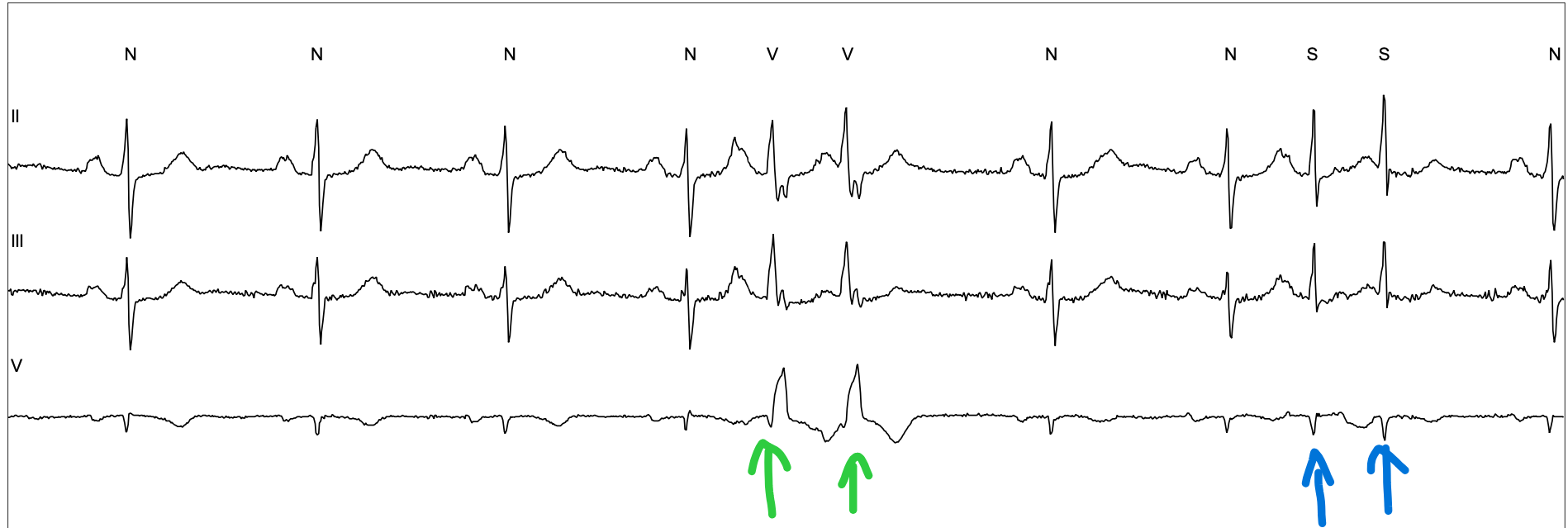 Extra heart beats after ablation