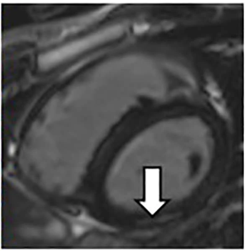 Covid and Atrial Fibrillation