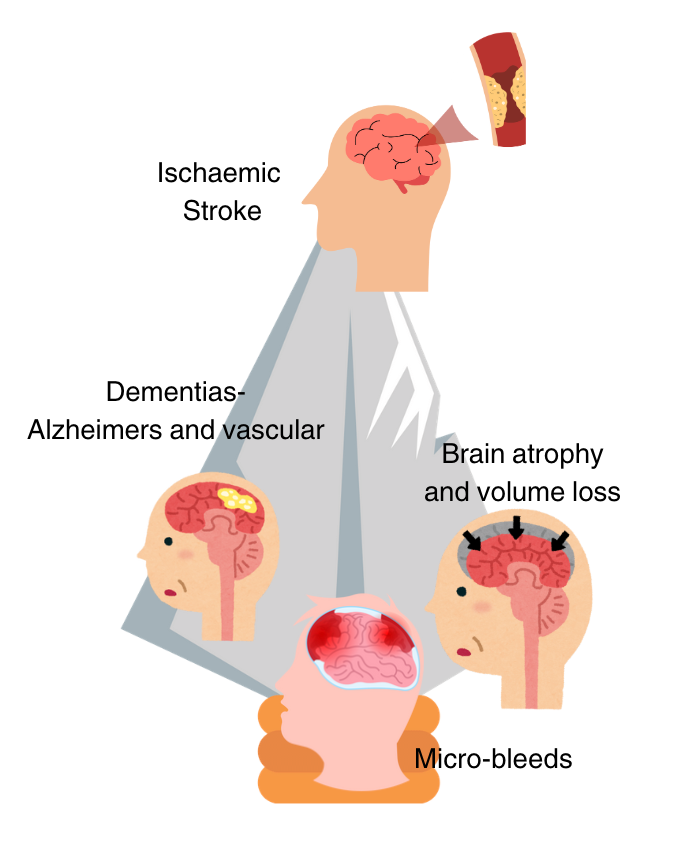 Atrial Fibrillation and Dementia