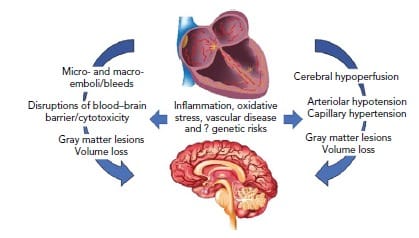 Atrial Fibrillation and Dementia