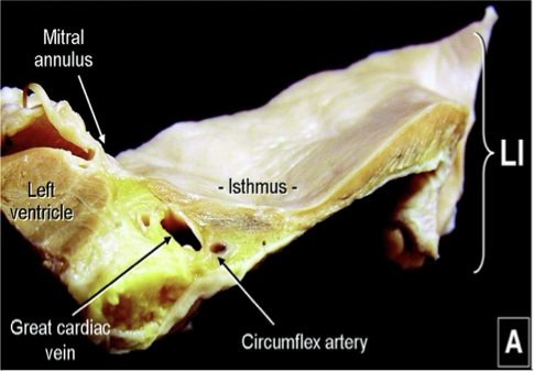 AFib Ablation from outside the heart