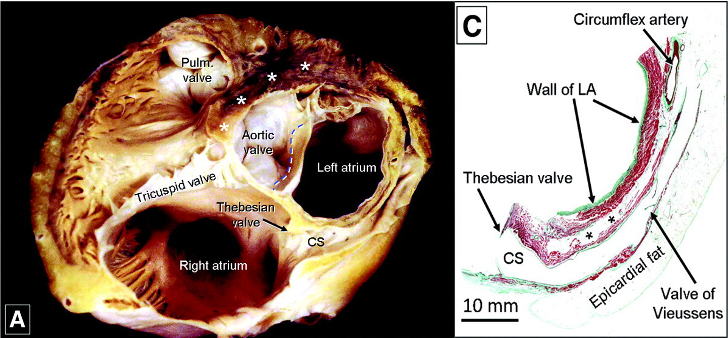 AFib Ablation from outside the heart