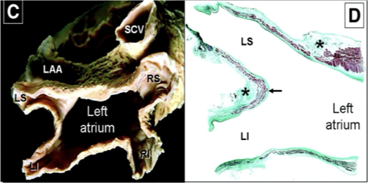 AFib Ablation from outside the heart