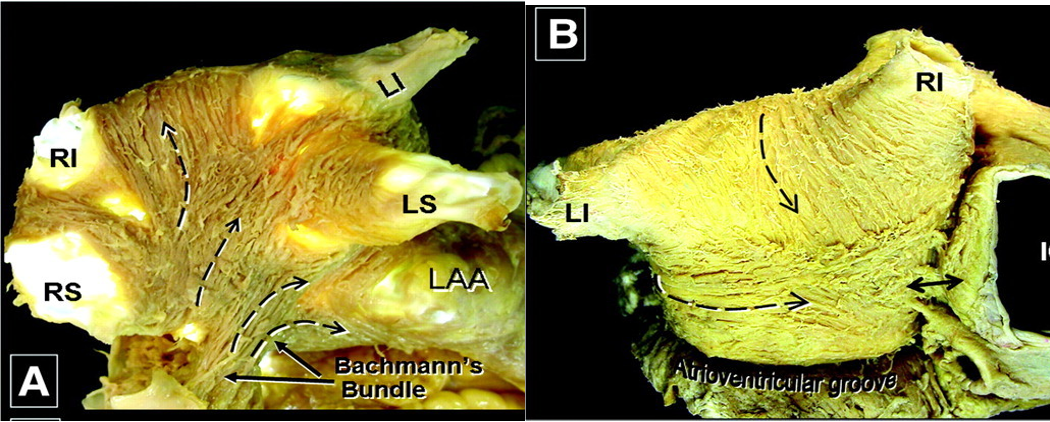 AFib Ablation from outside the heart