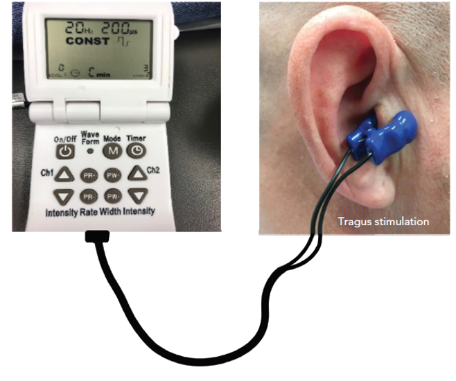 Ear stimulation: A new approach to AFib treatment