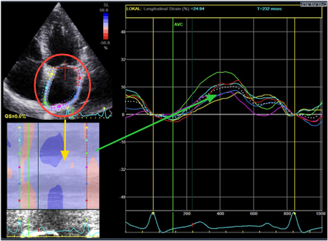 Should I stop my blood thinner after ablation?