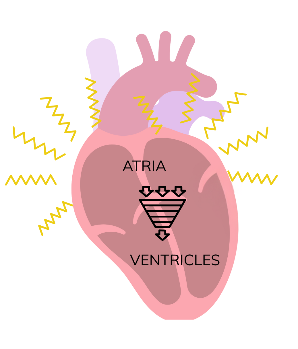 Slow Atrial Fibrillation slow-atrial-fibrillation